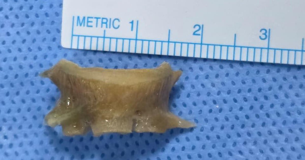 Dubai doctors pull 2cm fish bone from man's airway after two-month ordeal
